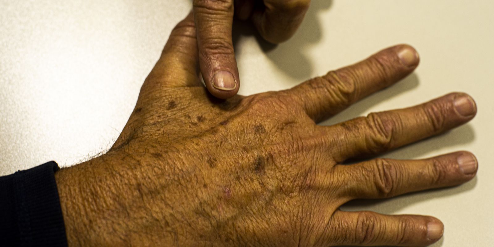 Falta de dados sobre câncer de pele prejudica prevenção e políticas públicas, aponta estudo